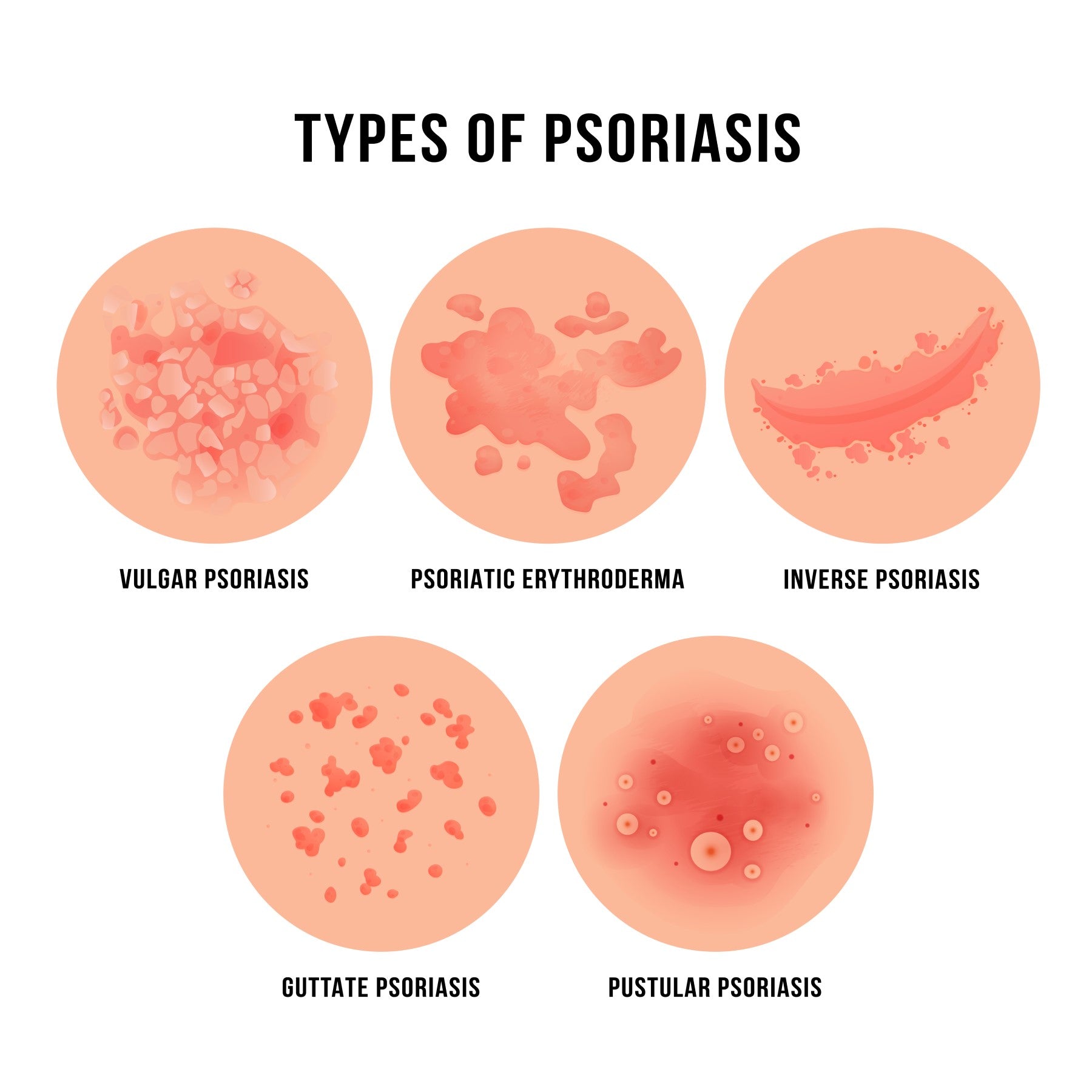 Types of Psoriasis