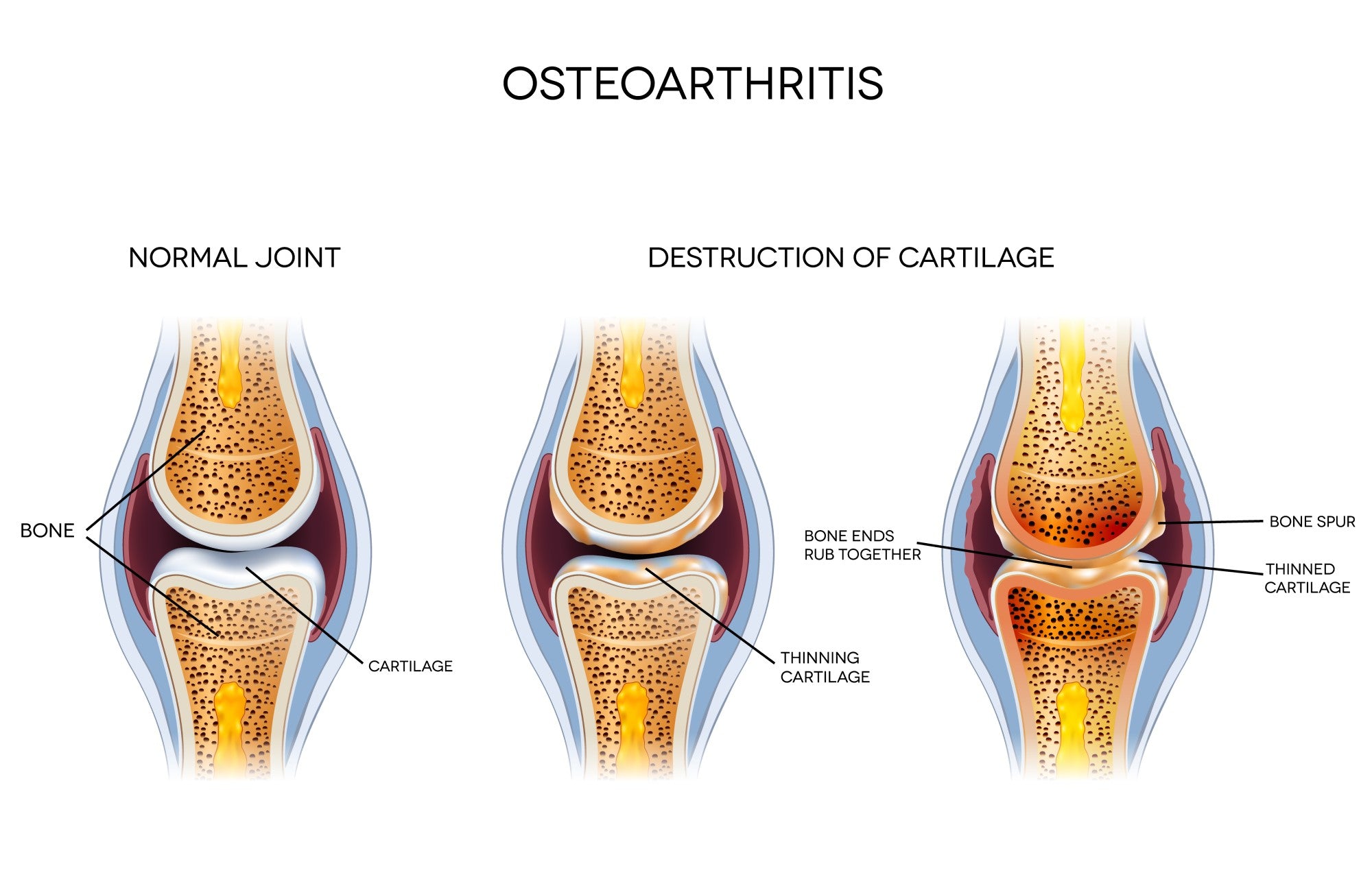 Progression of Knee Osteoarthritis