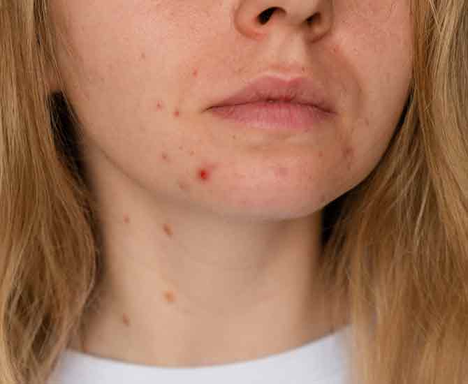 Photo of woman with hormonal acne on chin