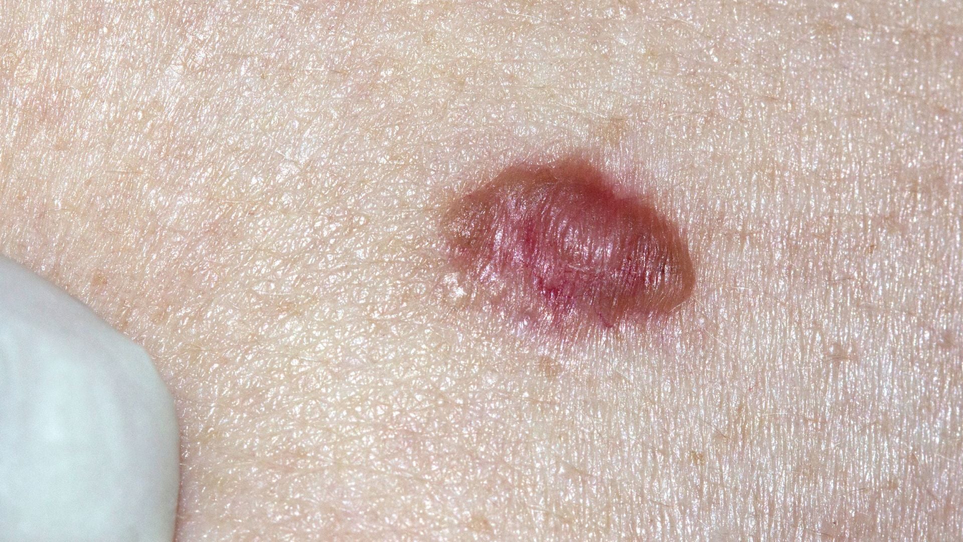 Basal Cell Carcinoma