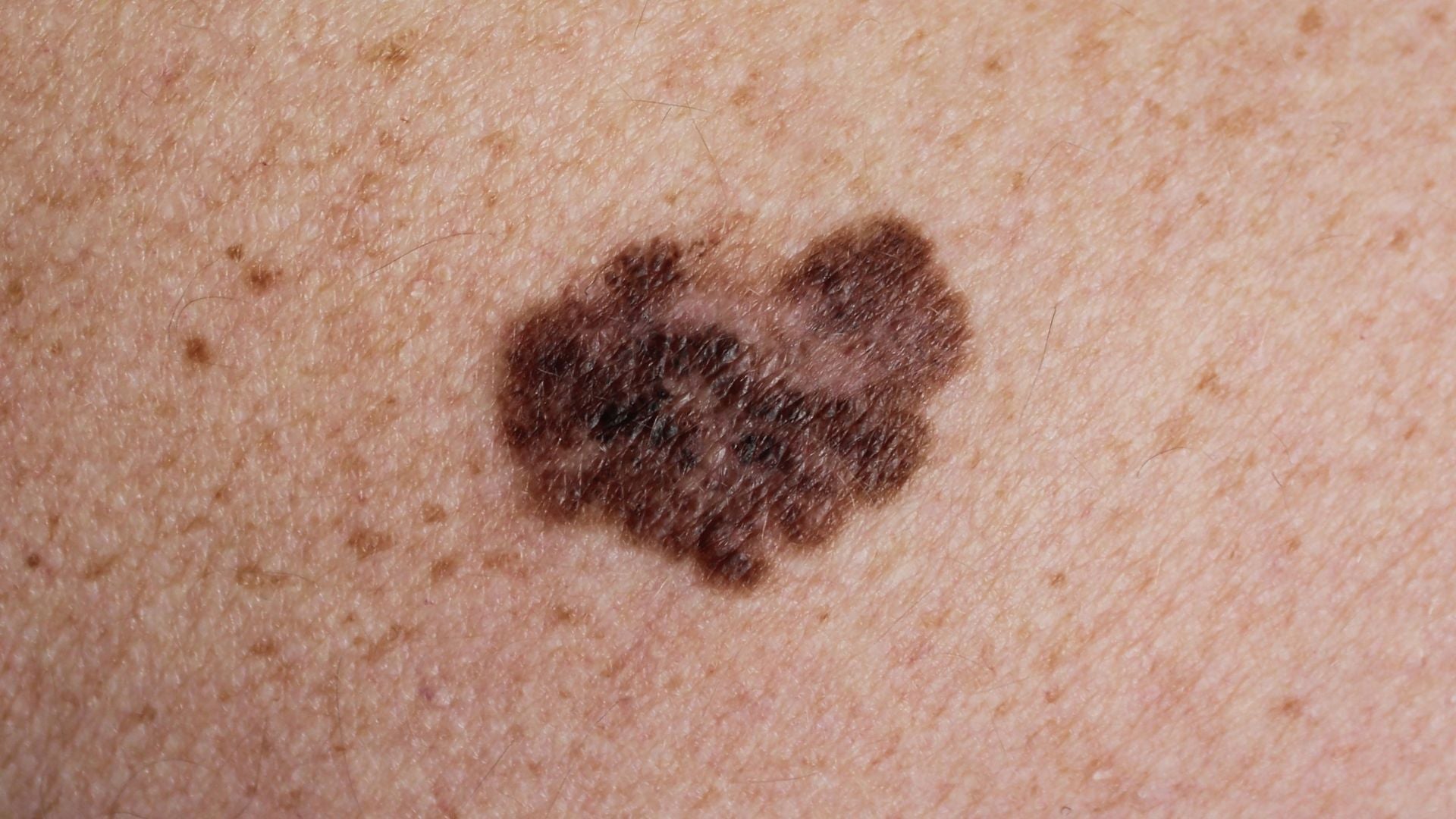 Basal Cell Carcinoma