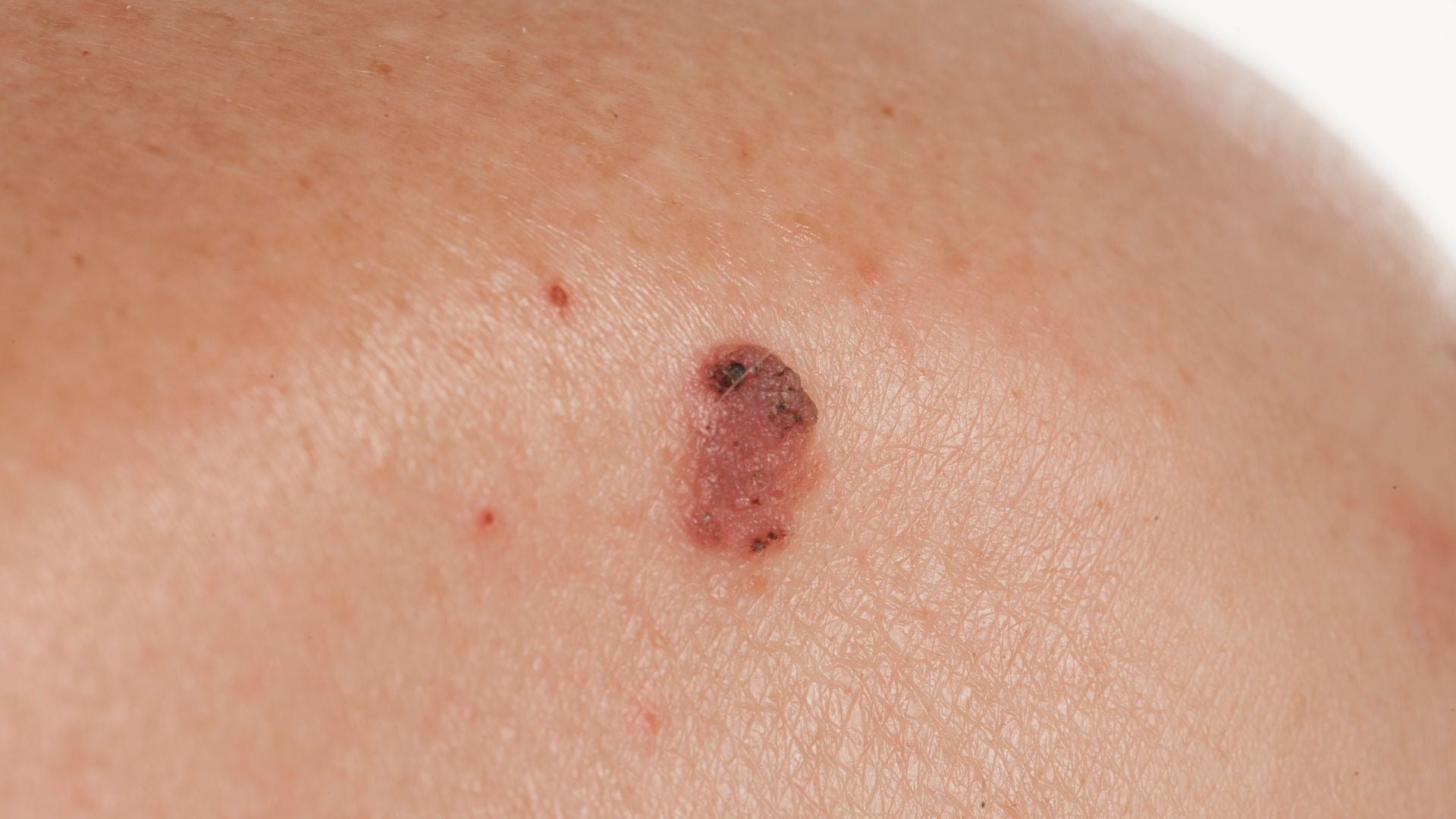 Basal Cell Carcinoma