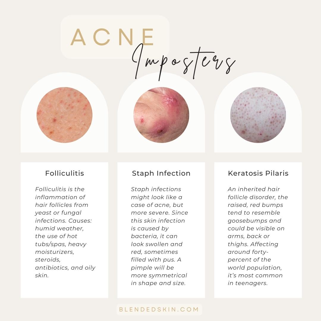 Acne Imposters - Blended Skin