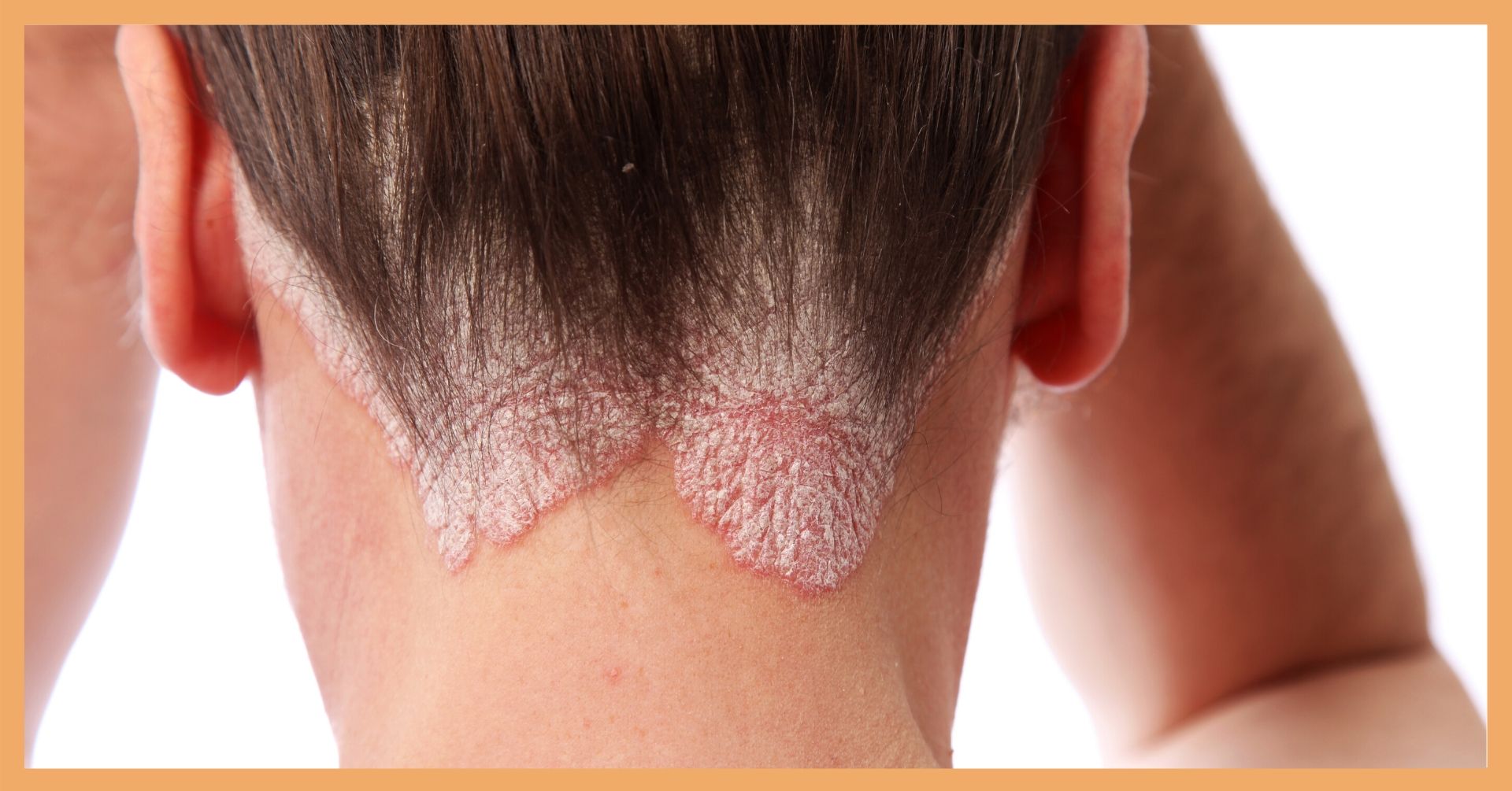 Can Scalp Psoriasis Cause Hair Loss Delfina Skin™