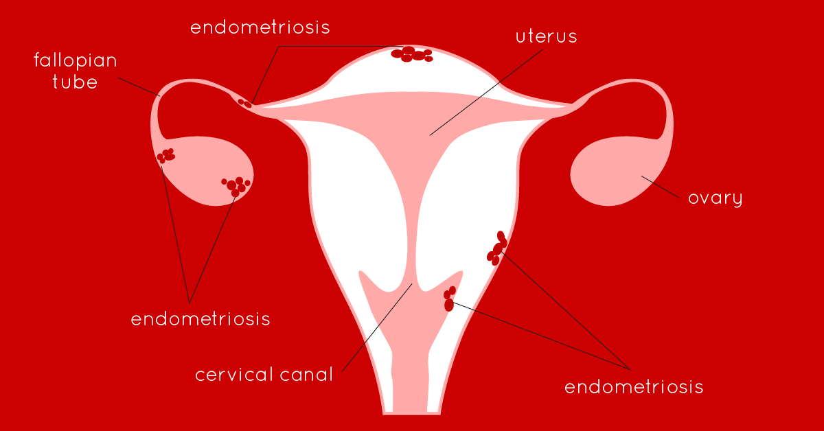 Aguacate y endometriosis