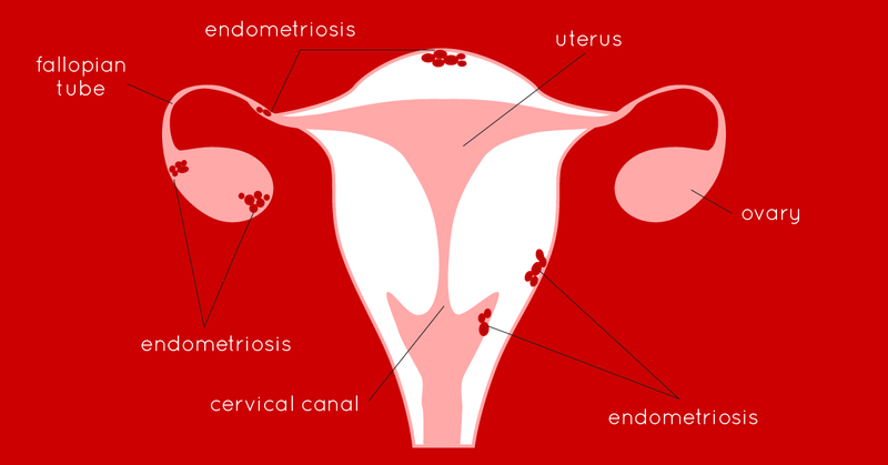 Endometriosis - Ruby Cup