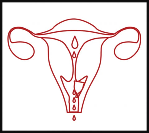  Ruby Cup image of a menstrual cup inserted too high in the vagina below the cervix