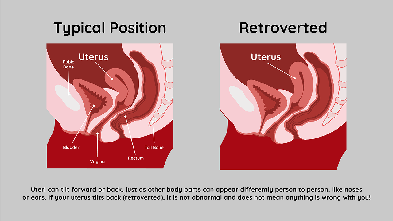 image of normal uterus position and tilted uterus