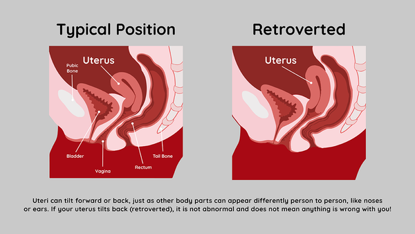 Typical position of uterus versus retroverted uterus