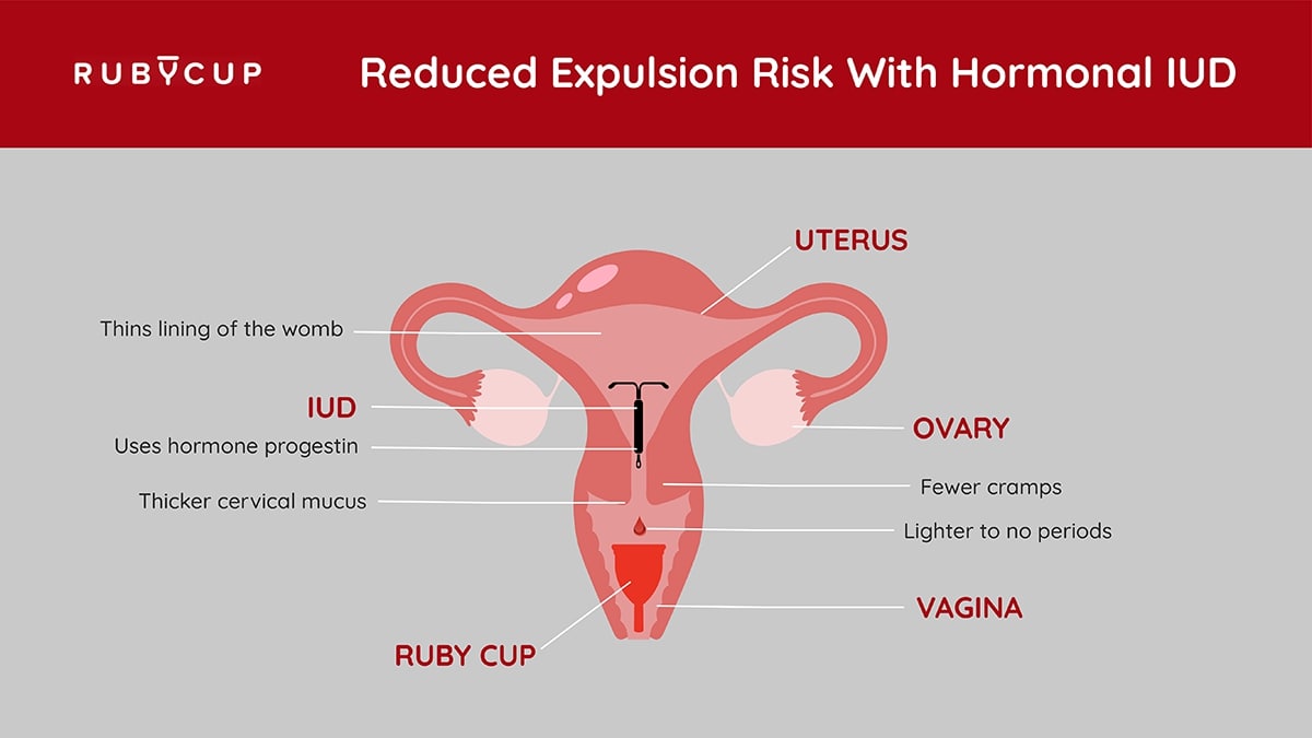 reduced risk of expulsion with hormonal iud