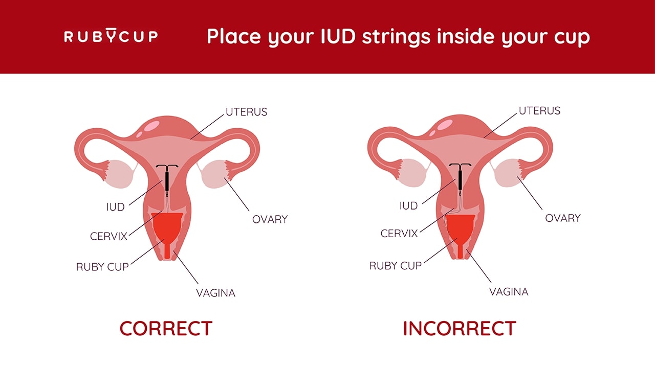 IUD placement with a menstrual cup