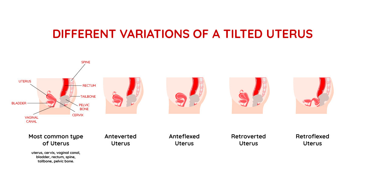 types of tilted uterus