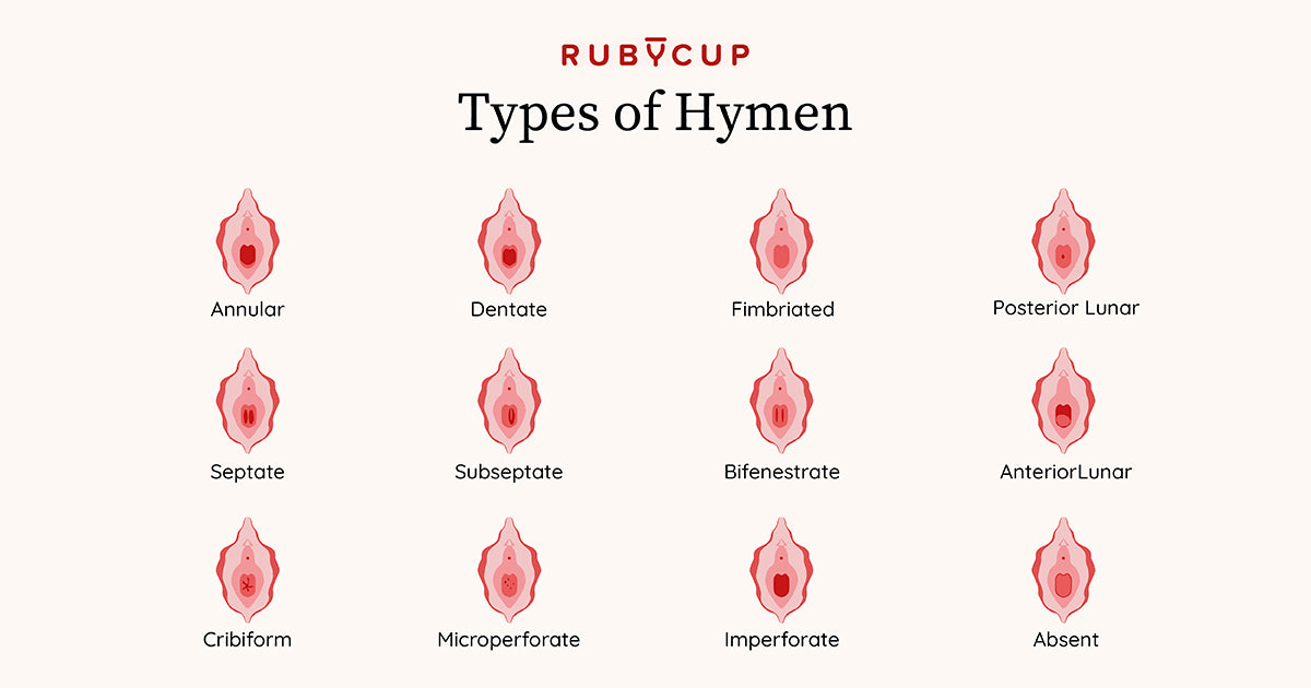 Definition: 01 Ruby Cup image of the different types of hymens