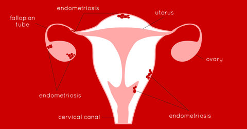 What is endometriosis