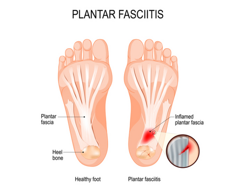 Plantar Fasciitis: Do and Don't Exercises | Carrothers Orthopaedics