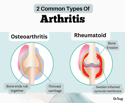 Arthritis Pain Relief