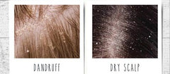 Dandruff verses a dry scalp