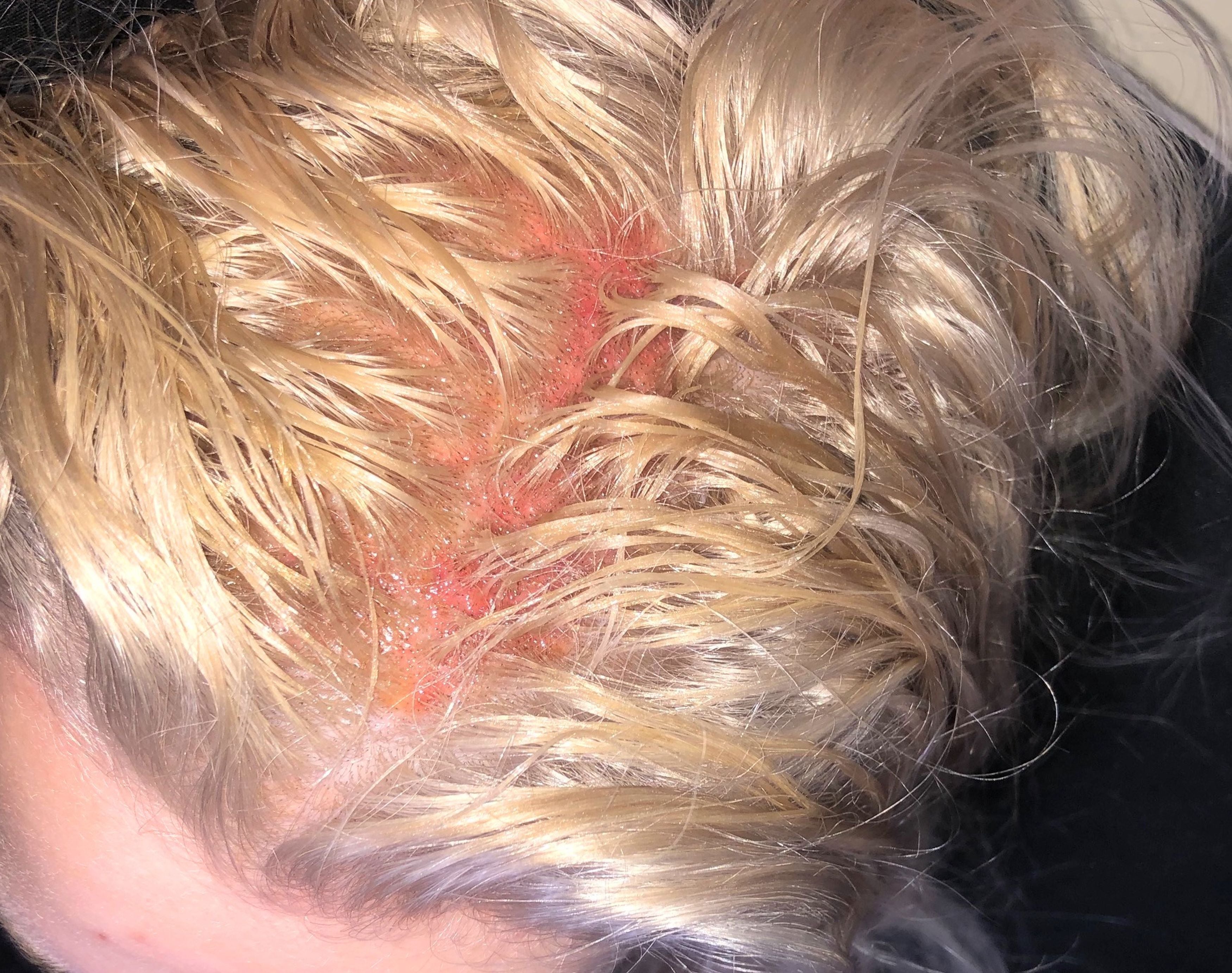 Severe bleach burns on the scalp