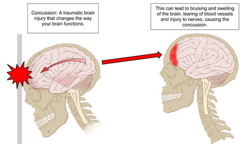 Concussion in Rugby