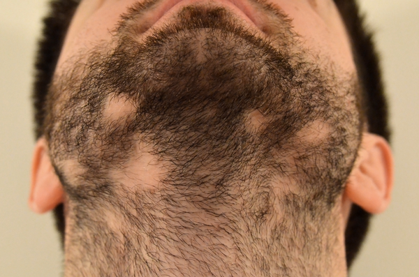 Man with patchy beard