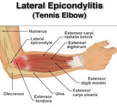 pickleball elbow