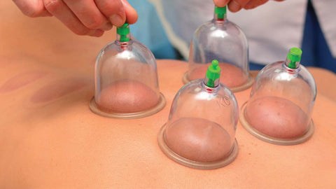 Therapeutic Cupping Helps Remove Stagnation And Toxins To Reduce Joint And Muscle Pain, Alleviate Tightness, And Induce Blood Circulation