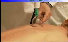 What Is Cupping Therapy