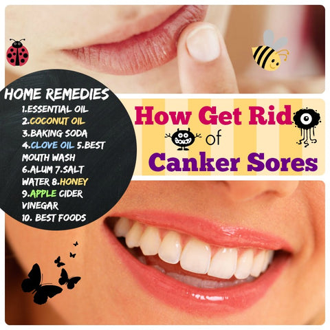 Canker Sore Treatment (How to Get Rid of Canker Sores)