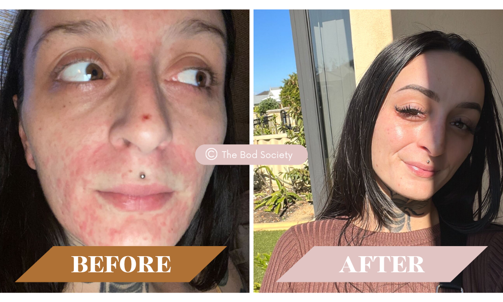 Before and After Acne The Bod Society Illuminate Glow Oil and Breakout Serum