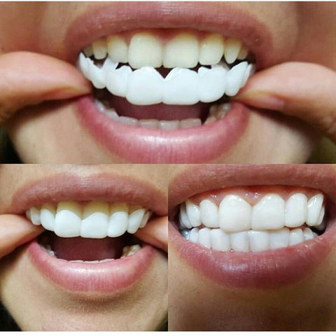 invisalign