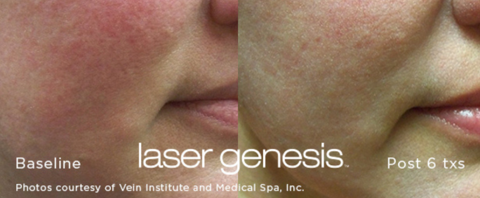 Laser_Genesis before and after redness disappearing 
