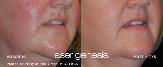Laser Genesis before and after post 7 treatments 