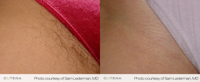 Laser hair removal before and after on Bikini line with permanent results