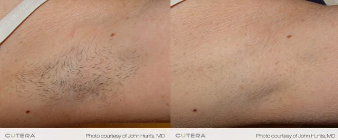 Laser hair removal before and after underarms with significant permanent results