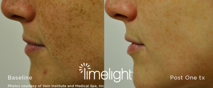 LimeLight before and after sun spots removed