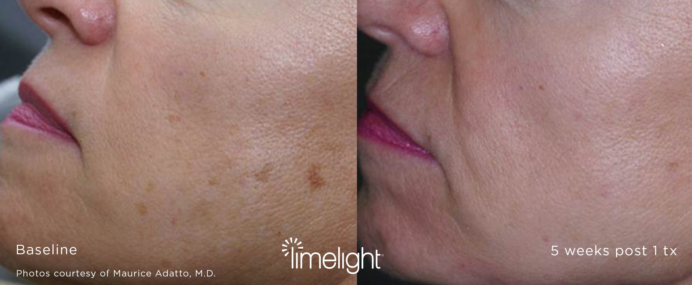 LimeLight before and after - brown spots removed