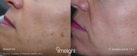 LimeLight Treatment - Before and after