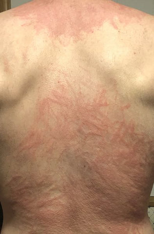 back eczema