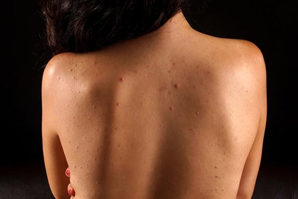 causes of back acne
