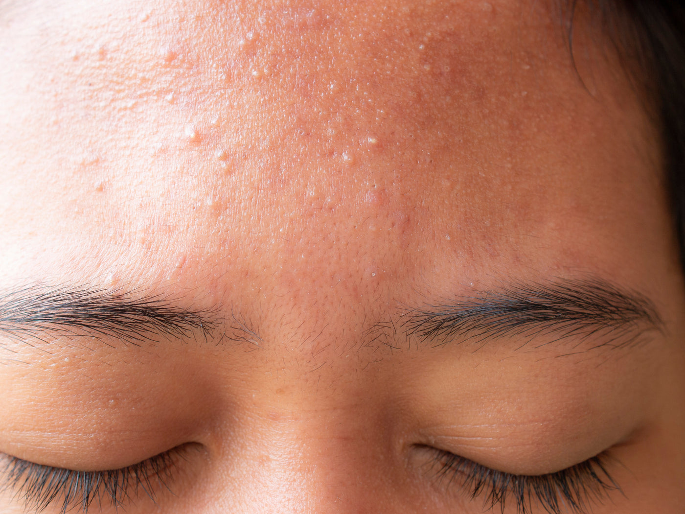 have-tiny-under-the-skin-bumps-on-your-forehead-zitsticka-uk