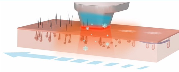 Laser à diode d'épilation 808 nm À des fins non médicales - AurelijosSPA