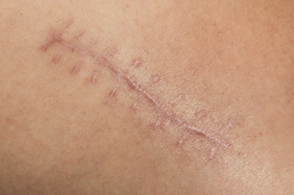 How to Get Rid of Scars: 5 Proven Treatments