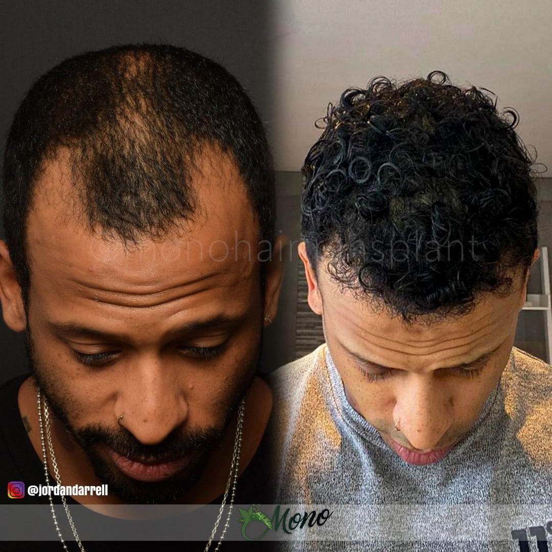 Hair Transplant Turkey - NurHair Center