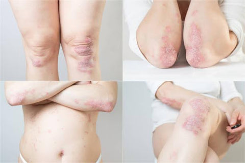 psoriasis