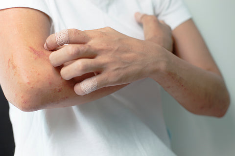 Coping with Eczema & Psoriasis | Derma MD Canada