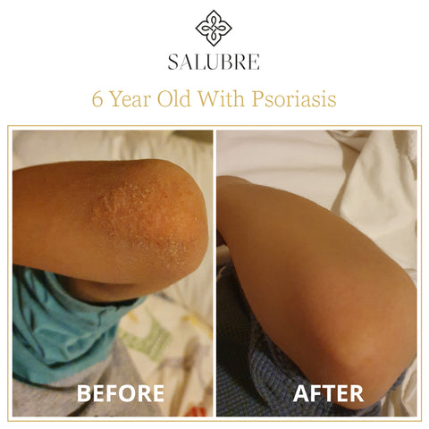 Psoriasis before and after treatment Salubre Therapeutic Range