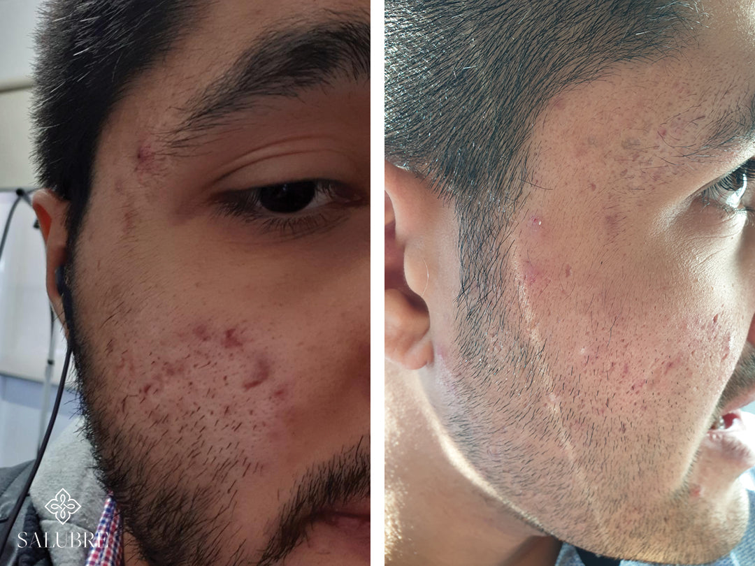Acne before and after images
