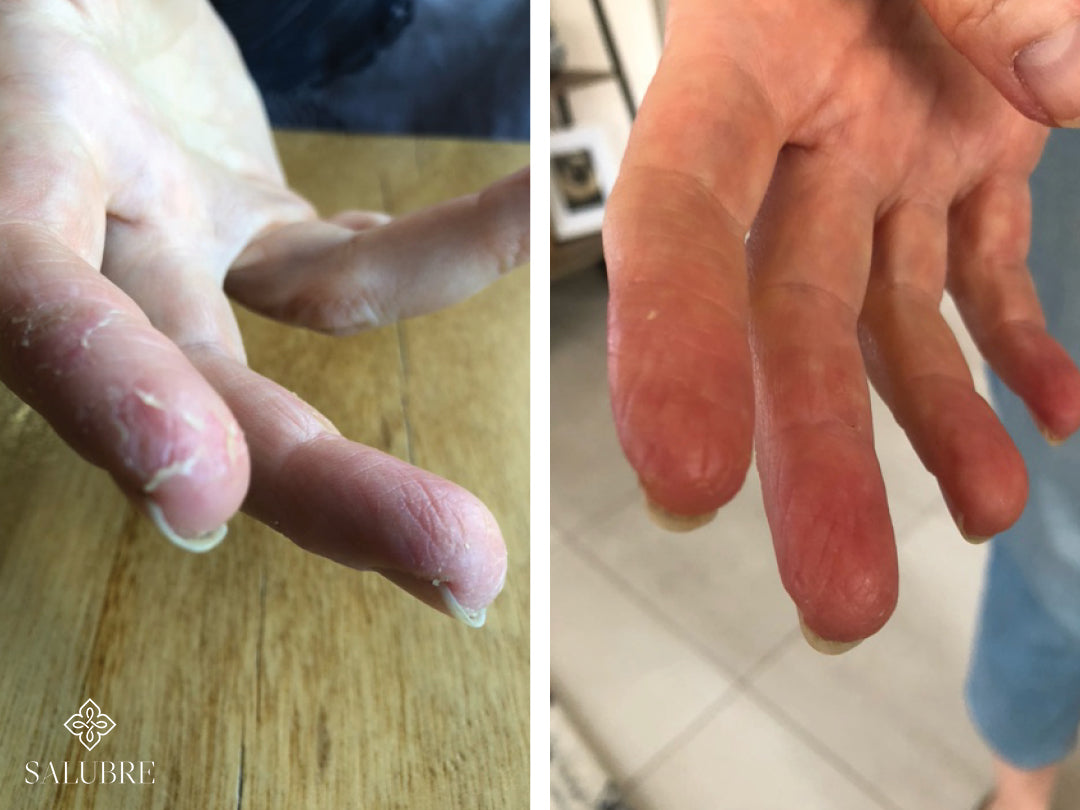 Dermatitis on hands before and after images