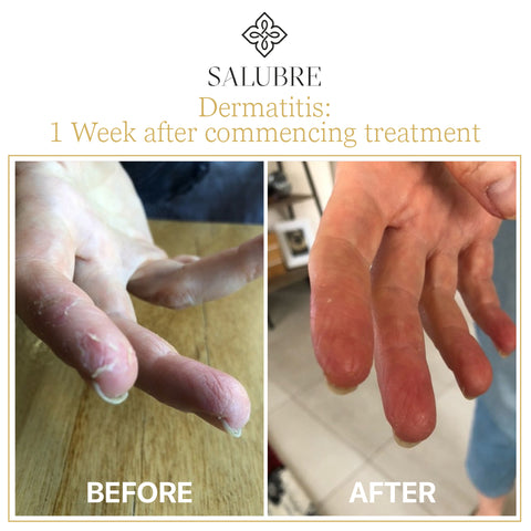 Dermatitis before and after applying Salubre Revitalising Scalp and Body Cream
