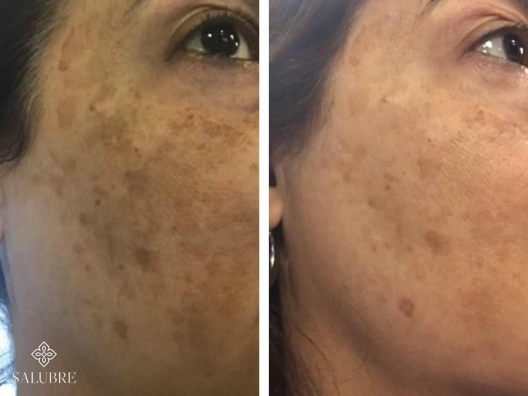 Hyper-pigmentation before and after treatment image